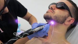 Laser Hair Removal for Men in NYC
